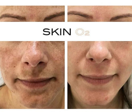 Skino2pigmentationfreckles_723x723_edited.jpg