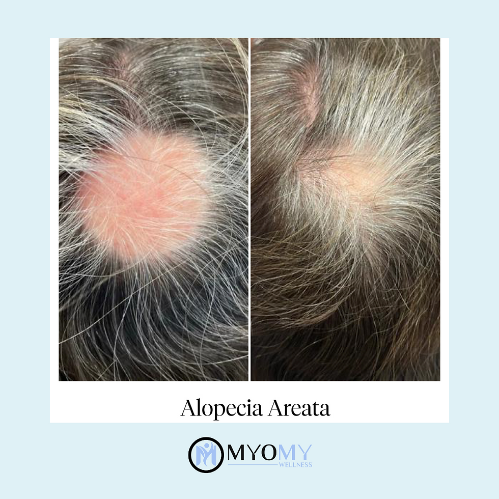 Thumbnail: CALECIM ADVANCED 6 WEEK IN-CLINIC HAIR LOSS TREATMENT PROGRAM