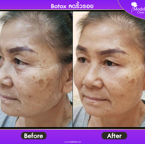 1100-1000 line Botox ลดริ้วรอย MODELLA.jpg