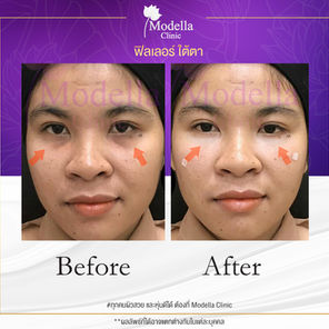 LINE BEFORE AFTER ฟิลเลอร์ 06.jpg