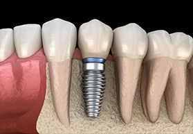 dental-implants-3.jpg