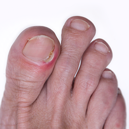 Nahaufnahme eines entzündeten, eingewachsenen Zehennagels