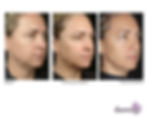 Thermage Before and After photos