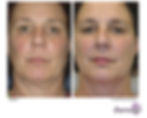 Thermage Before and After photos