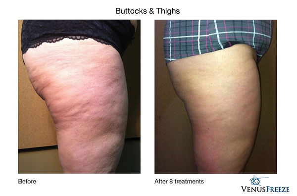 VF THigh 2_edited.jpg