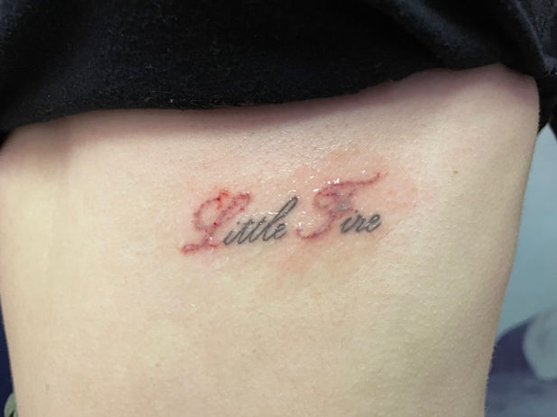 Tattoo Removal