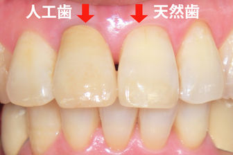 人工歯と天然歯