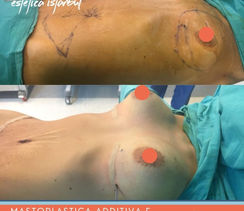 Mastoplastica Additiva e Addominoplastica in Turchia by Estetica Istanbul.JPG