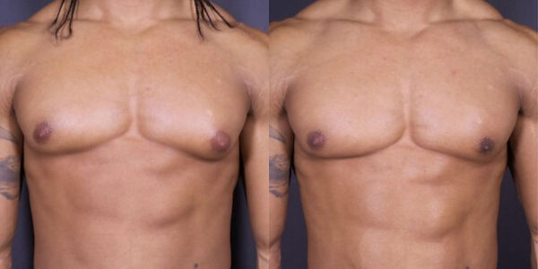 ginecomastia_uomo_estetica_istanbul-10.j