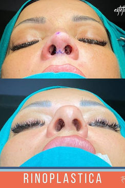 Rinoplastica in Turchia by Estetica Istanbul