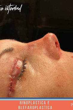 Rinoplastica in Turchia by Estetica Istanbul