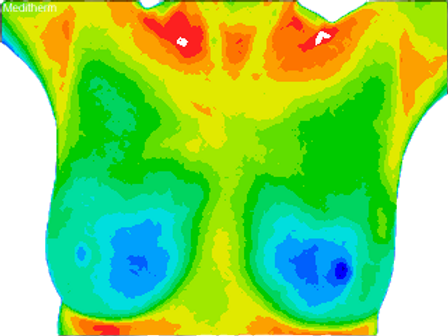 Normal anterior breast view w_permission