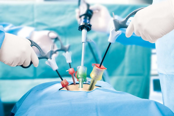 Cure de Hernie Inguinale par voie extraperitoneale coelioscopie