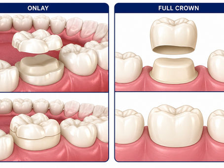 Onlays and Crowns: Why We Always Choose the Most Conservative Restoration
