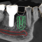 3D printed surgical guide used to plan precise dental implant placementDigitally Planned Implant.png