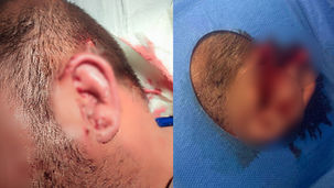 Lite con amputazione dell'orecchio a Santa Maria del Cedro: i fatti all'attenzione della procura