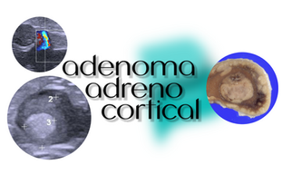 adenoma adrenocortical