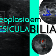 neoplasias de vesícula biliar