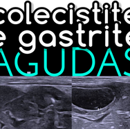 colecistite e gastrite agudas