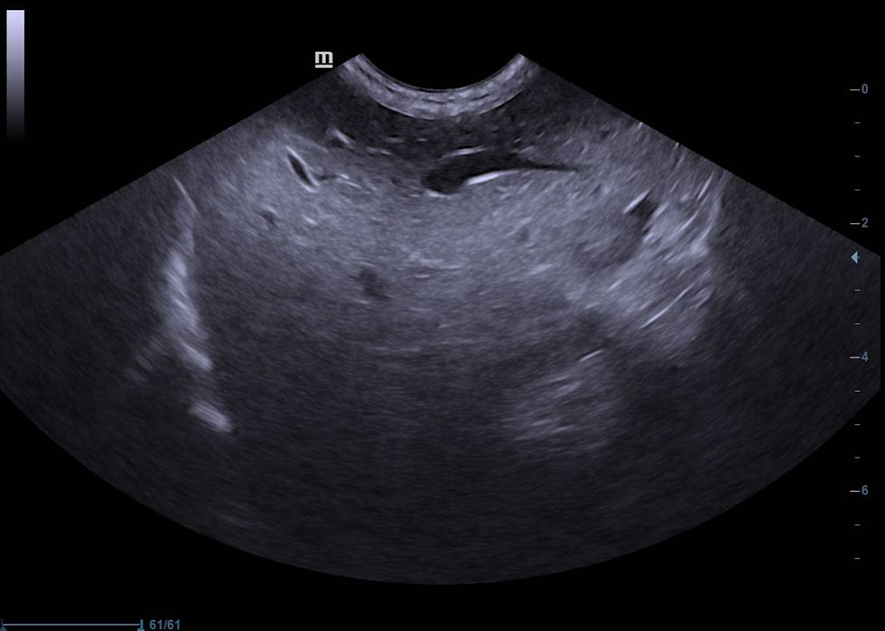 Infiltração gordurosa hepática: observar a hiperecogenicidade no campo proximal da imagem com atenuação de feixes distais