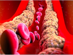 6 Simple Food Swaps That Can Naturally Lower High Triglycerides | Cardiologist in Vadodara