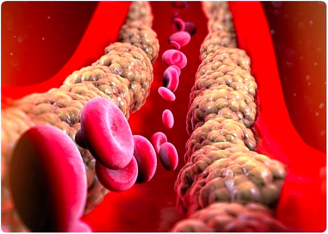 Triglycerides | Nidaan Heart | Best Cardiologist in Vadodara