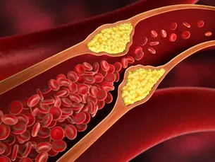 Cholesterol Explained: Warning Signs, Risks & How to Protect Your Heart