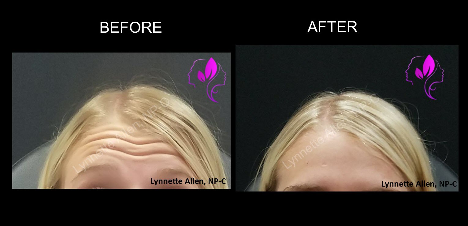 Faces Refreshed Before & Afters Botox, Fillers, PDO Threads