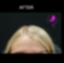Botox Forehead Wrinkles Before_After