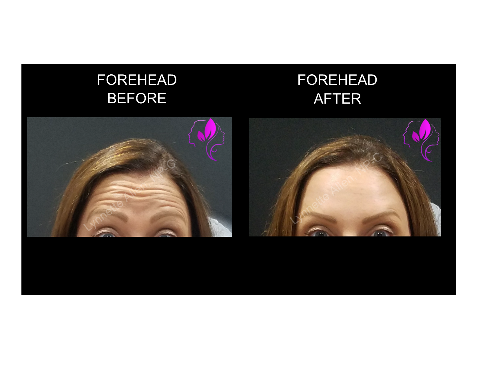 Faces Refreshed Before & Afters Botox, Fillers, PDO Threads