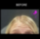 Botox Forehead Before_After