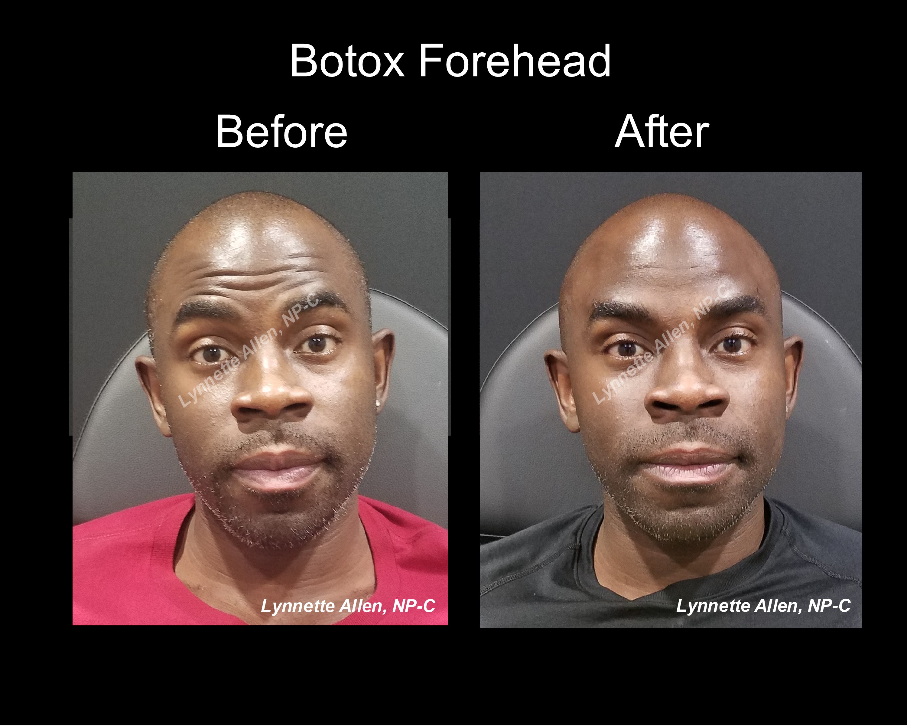 Faces Refreshed Before & Afters Botox, Fillers, PDO Threads