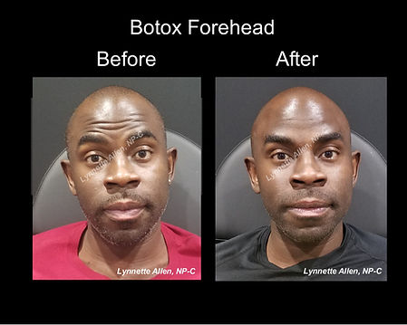 Botox for men before and after