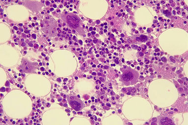 Leucemia.jpg