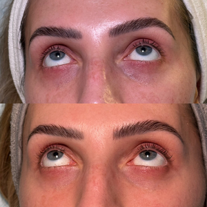 Undereye PRP Before & After