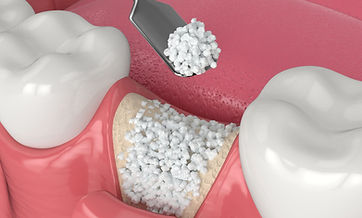 Will I Need a Bone Graft Before Getting Implants? dental treatment at Dr. Sonam Rambhia DDS in Tulare CA