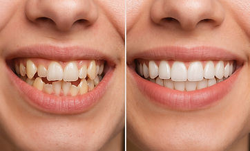 Smile Makeover Options Explained dental treatment at Dr. Sonam Rambhia DDS in Tulare CA