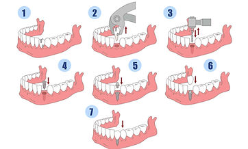Am I a Good Candidate for Dental Implants? dental treatment at Dr. Sonam Rambhia DDS in Tulare CA