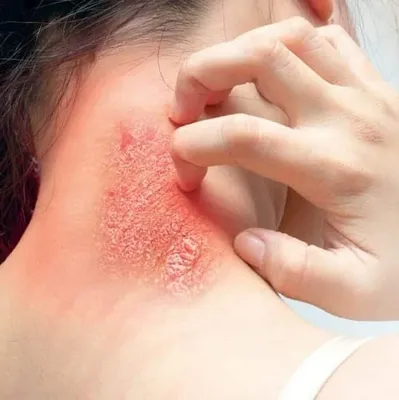 Fungal Infections
