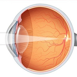 myopia