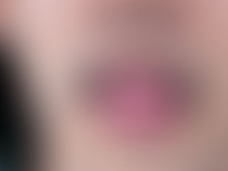 Man shows ulcer on tongue