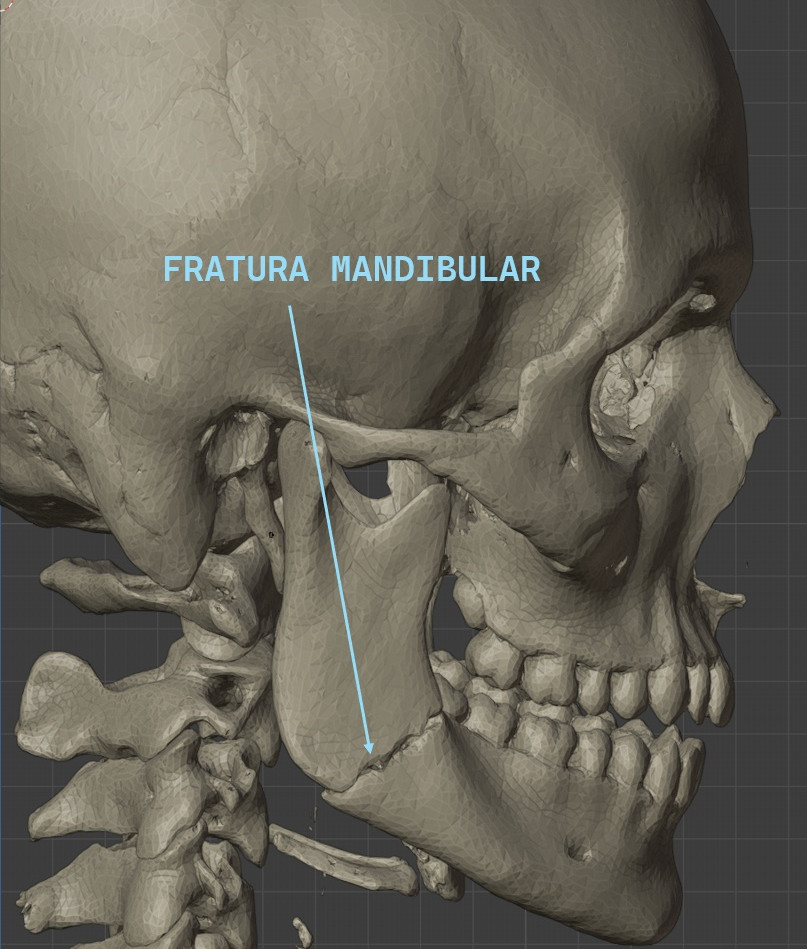 FRATURA MANDIBULAR  Dr DAVI SANDES