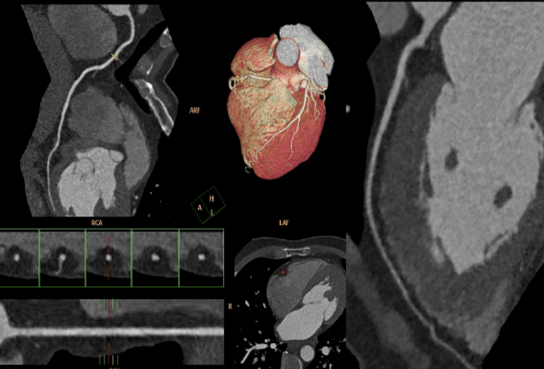 Μαγνητική Τομογραφία Καρδίας (CMR)