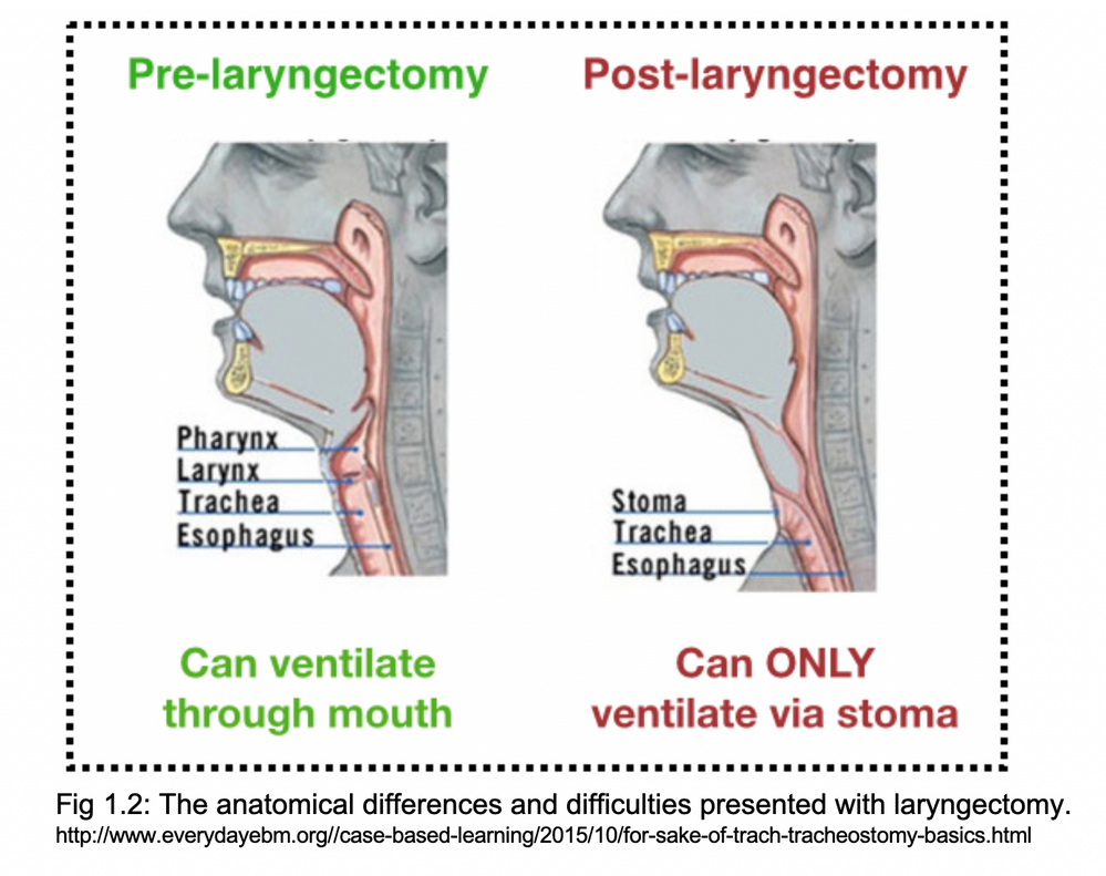 When A, B, and C Collide Tracheoinnominate Fistula Management