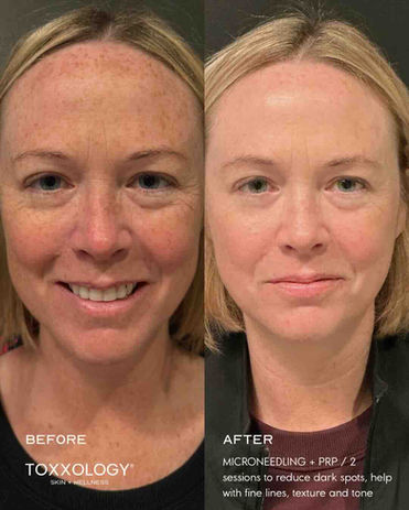 Microneedling PRP before and after in Nashville, TN