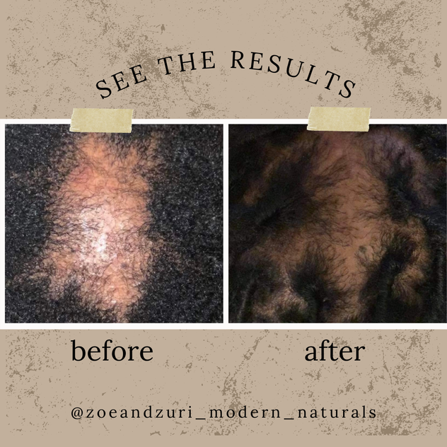 Haitian Black Castor Oil Alopecia Before and After