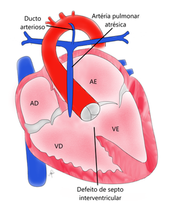 Tetralogia de Fallot 1 (vf)