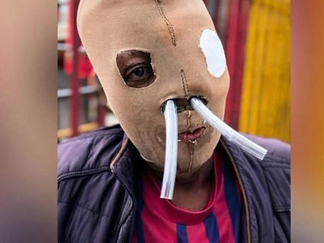 Autorizan eutanasia a María Consuelo Córdoba de 58 años que fue víctima de un ataque con ácido y se sometió a más de 80 cirugías