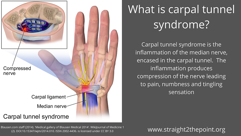 what-is-carpal-tunnel-syndrome-?
