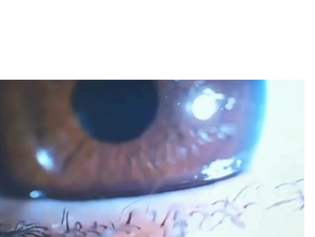 How your eyes show Adrenal fatigue, early detection #seeyourhealth #rootsteabar #iridology